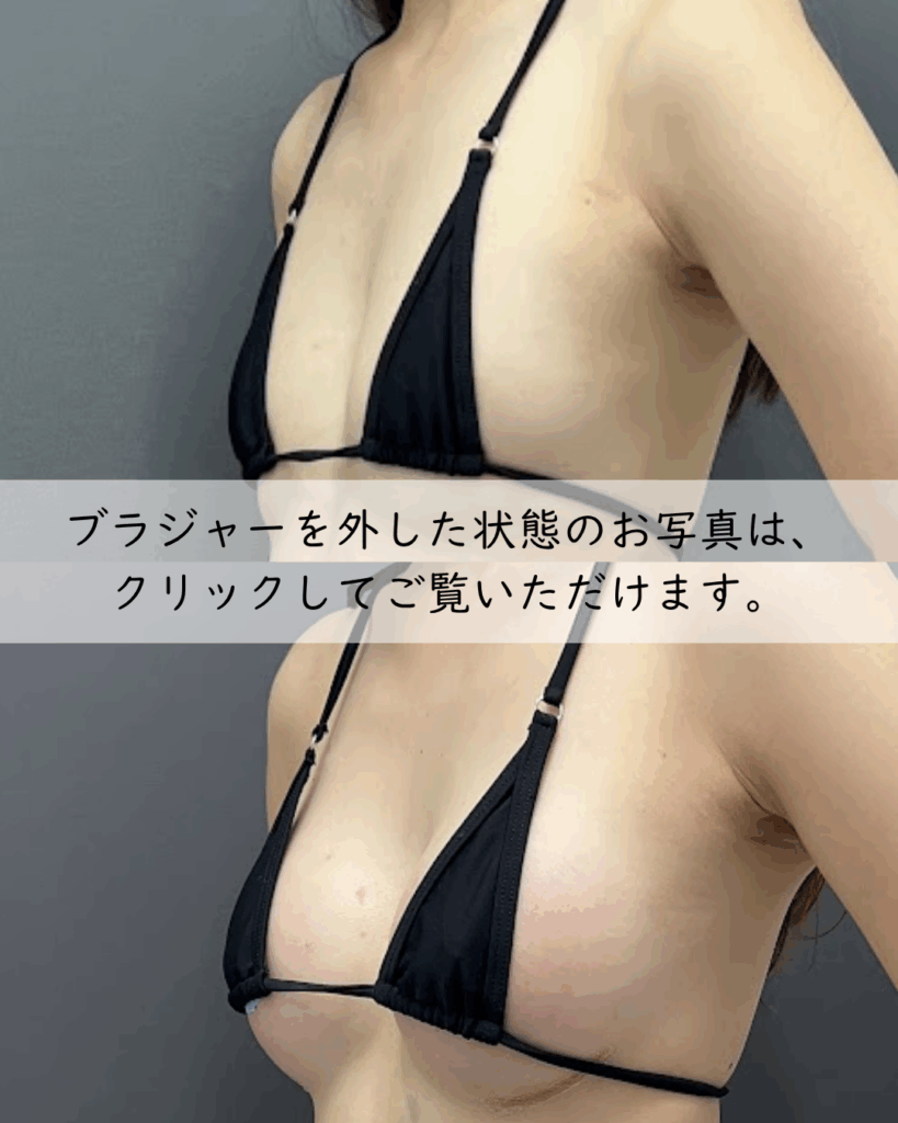 シリコンバッグ豊胸Motiva/Demi270