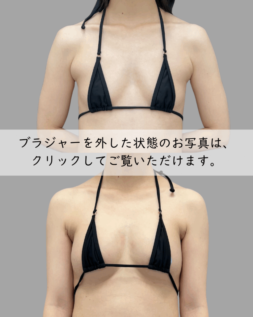 3次豊胸×副乳脂肪吸引