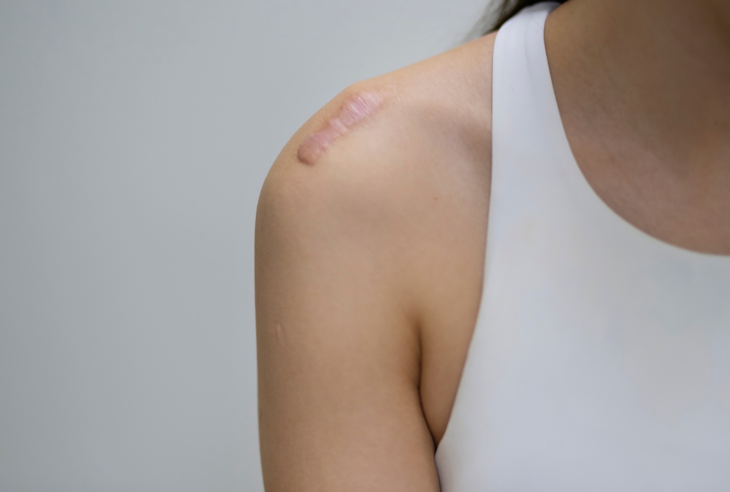 傷が盛り上がりやすい「ケロイド体質」の方は、体内でも瘢痕（＝硬い組織）が強く作られやすい傾向があります。
そのため、シリコンバッグ周囲のカプセルが硬くなりやすく、拘縮リスクが上がります。

当院ではケロイド体質の方には、