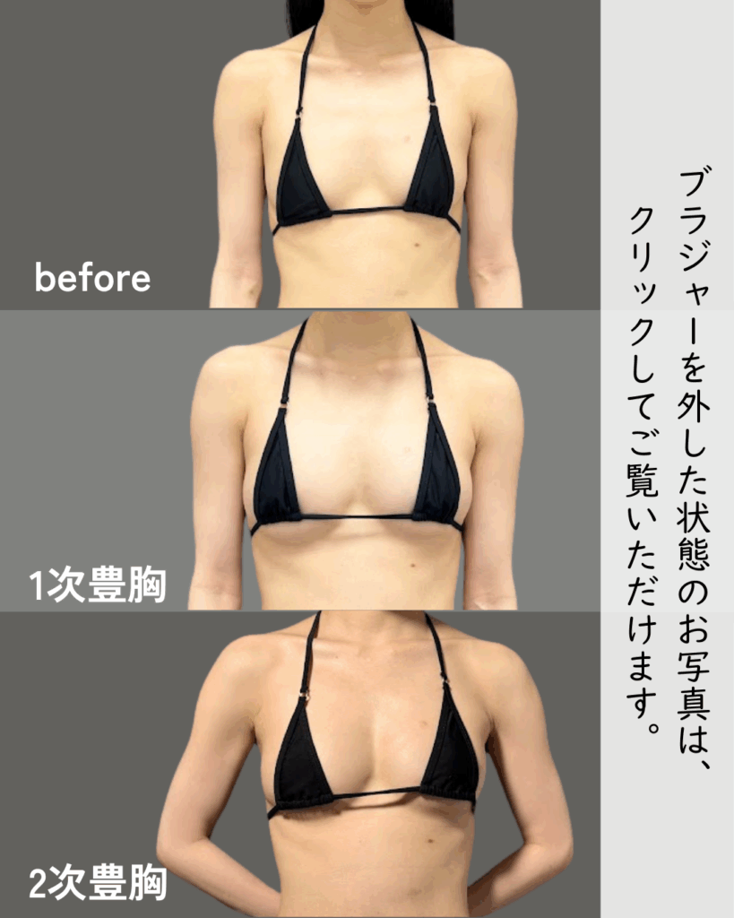 2次豊胸