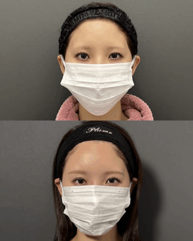 額こめかみ脂肪注入