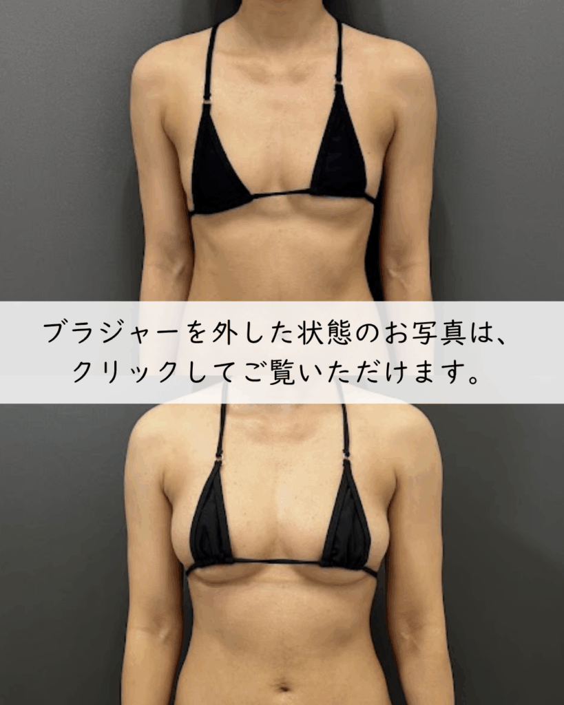 脂肪豊胸×副乳脂肪吸引