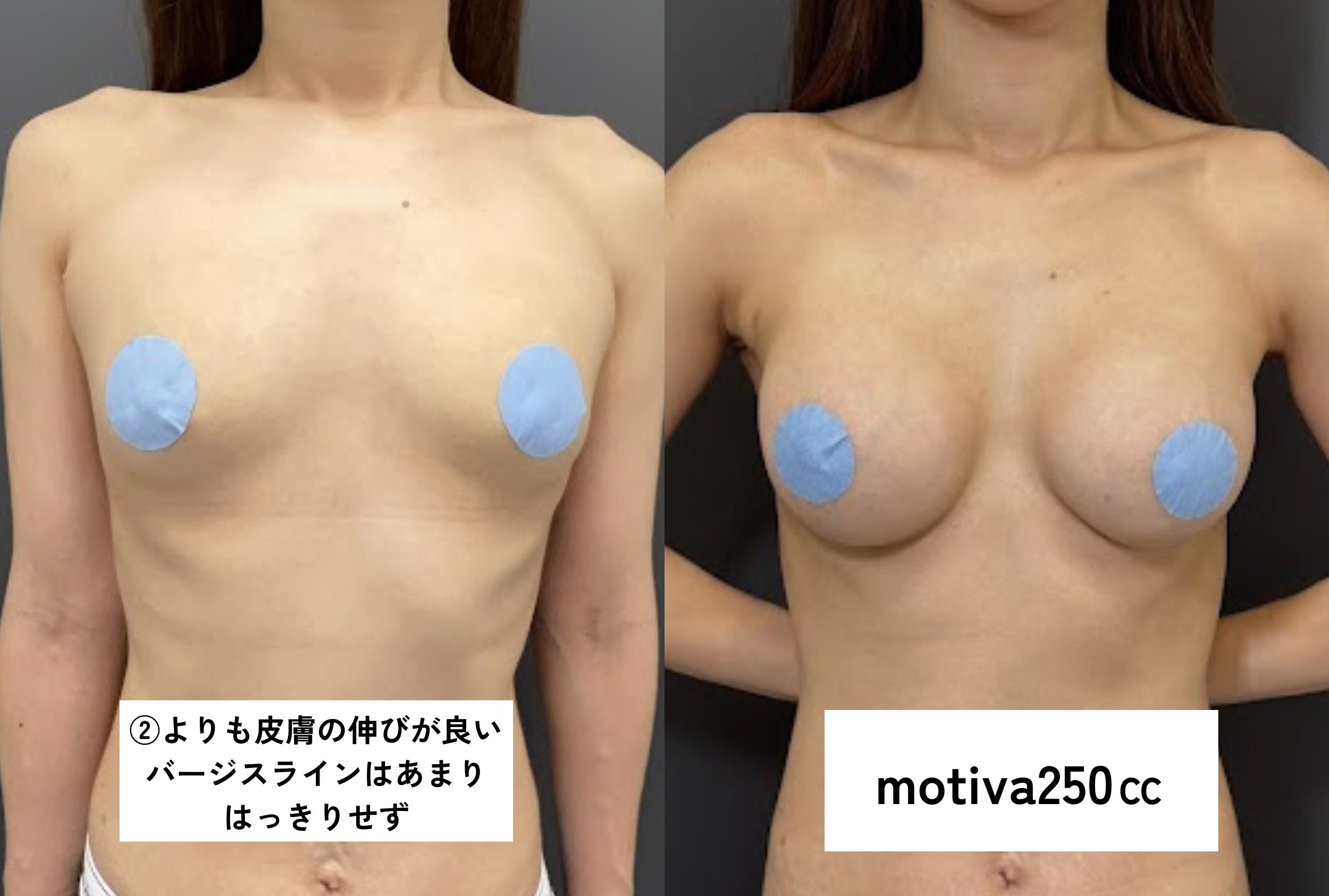 ・バージスなし/授乳歴あり/皮膚が硬い/乳腺あり（離れ胸）