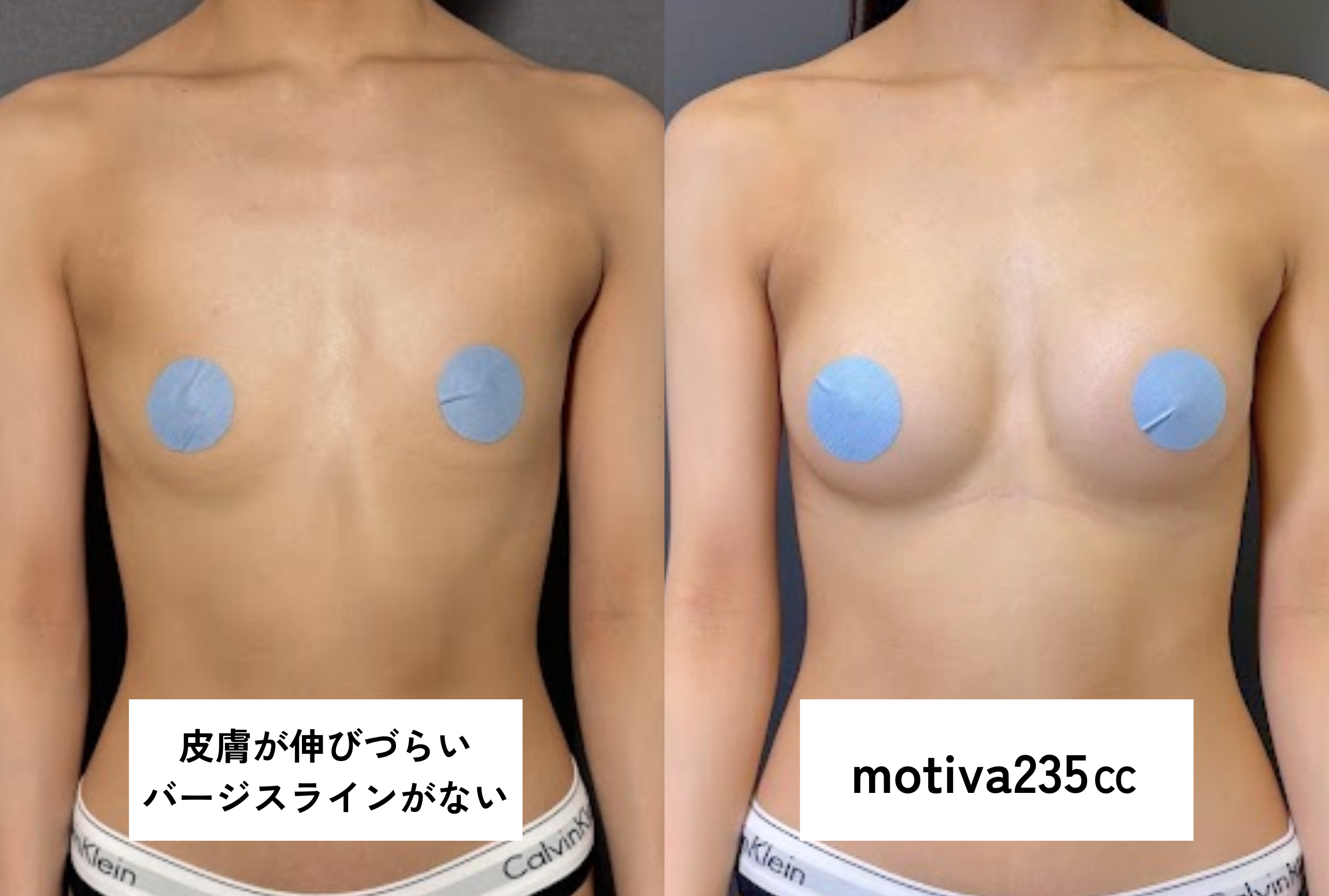 ・バージスなし/授乳歴・施術歴なし/皮膚が硬い（血管の透け・肋骨の浮きなし）/乳腺ほぼなし