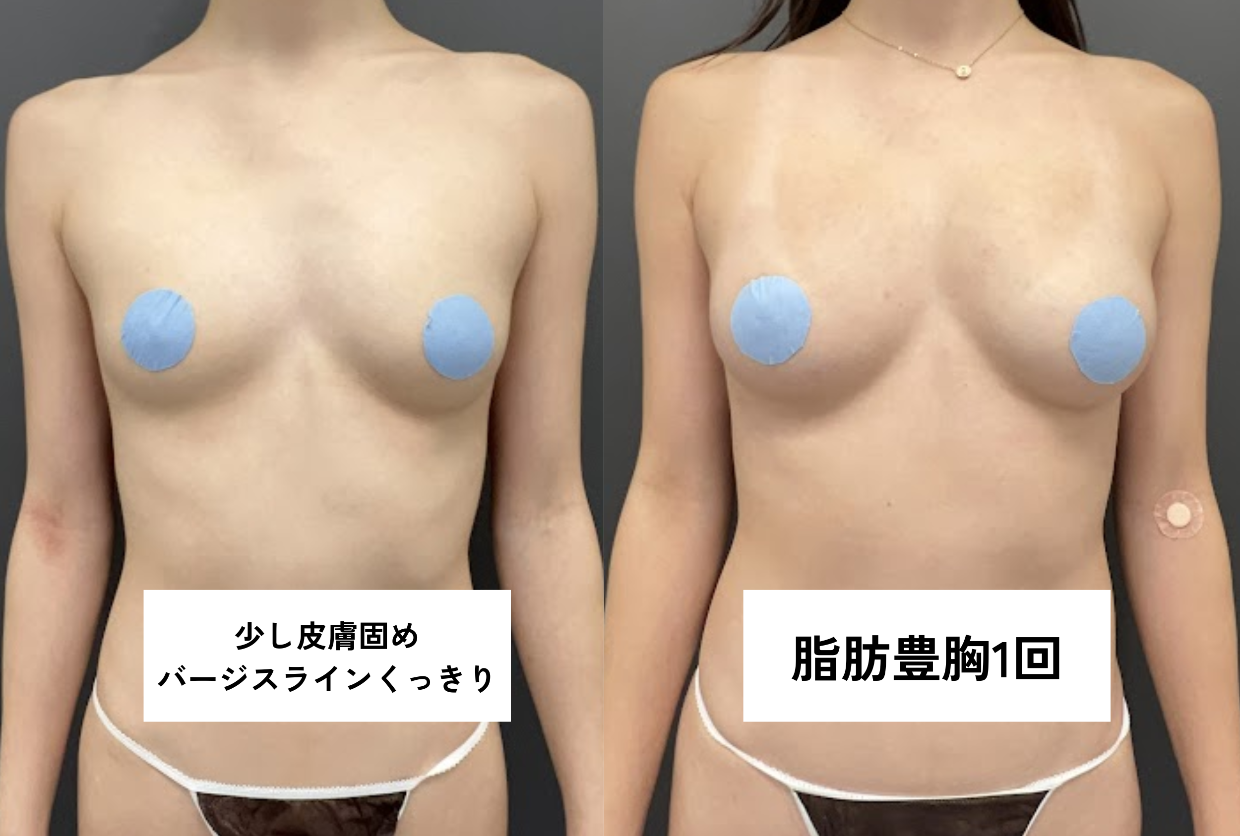 ・バージスあり/授乳歴・施術歴なし/皮膚やや硬め/乳腺あり