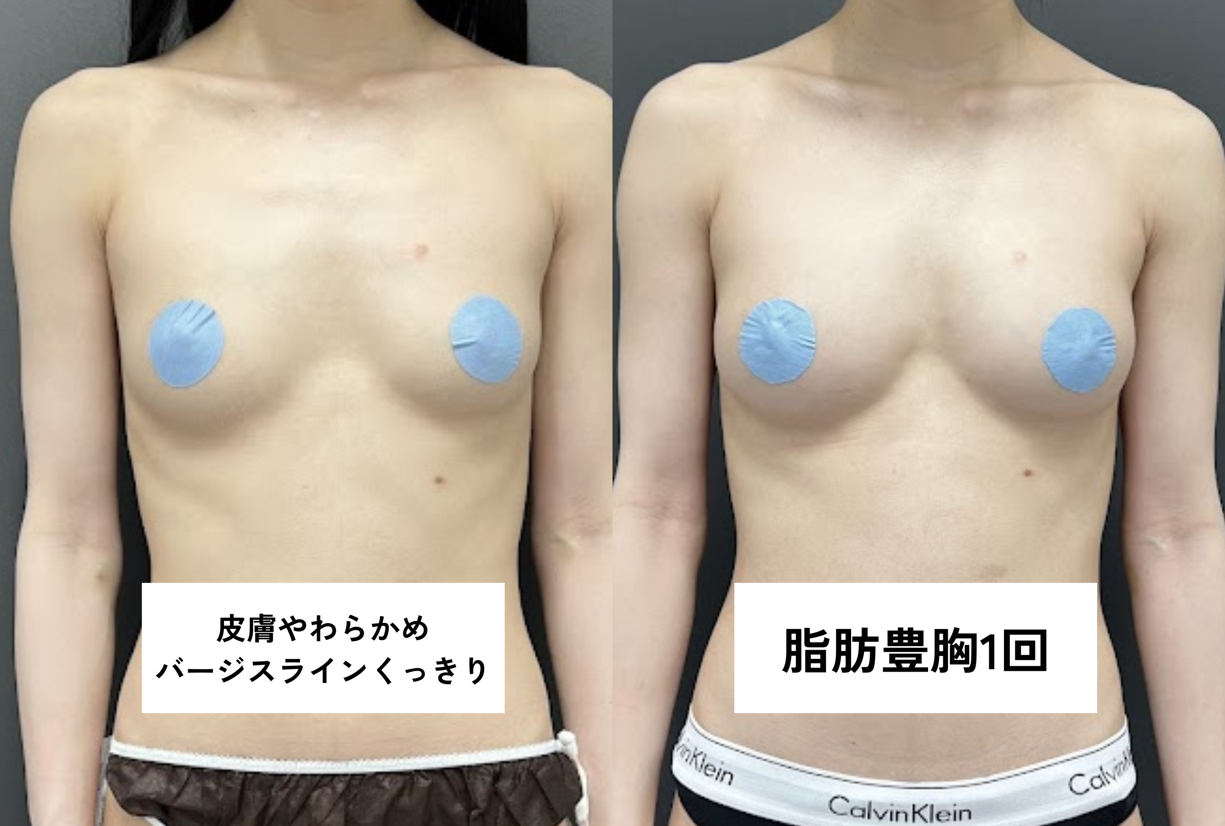 ・バージスあり/授乳歴なし/皮膚が柔らかい（肋骨の浮きあり）/乳腺あり