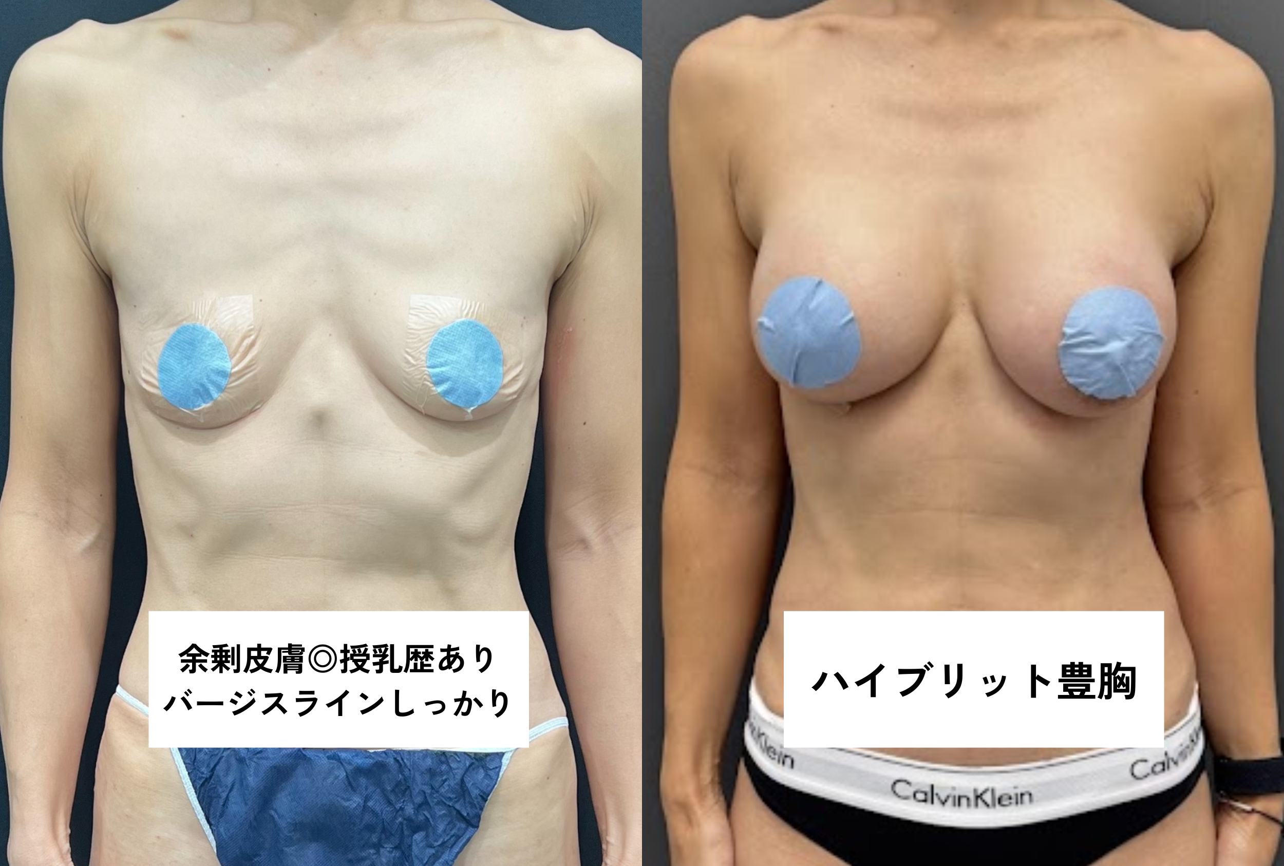 ・バージスあり/授乳歴あり/皮膚が柔らかい/乳腺あり