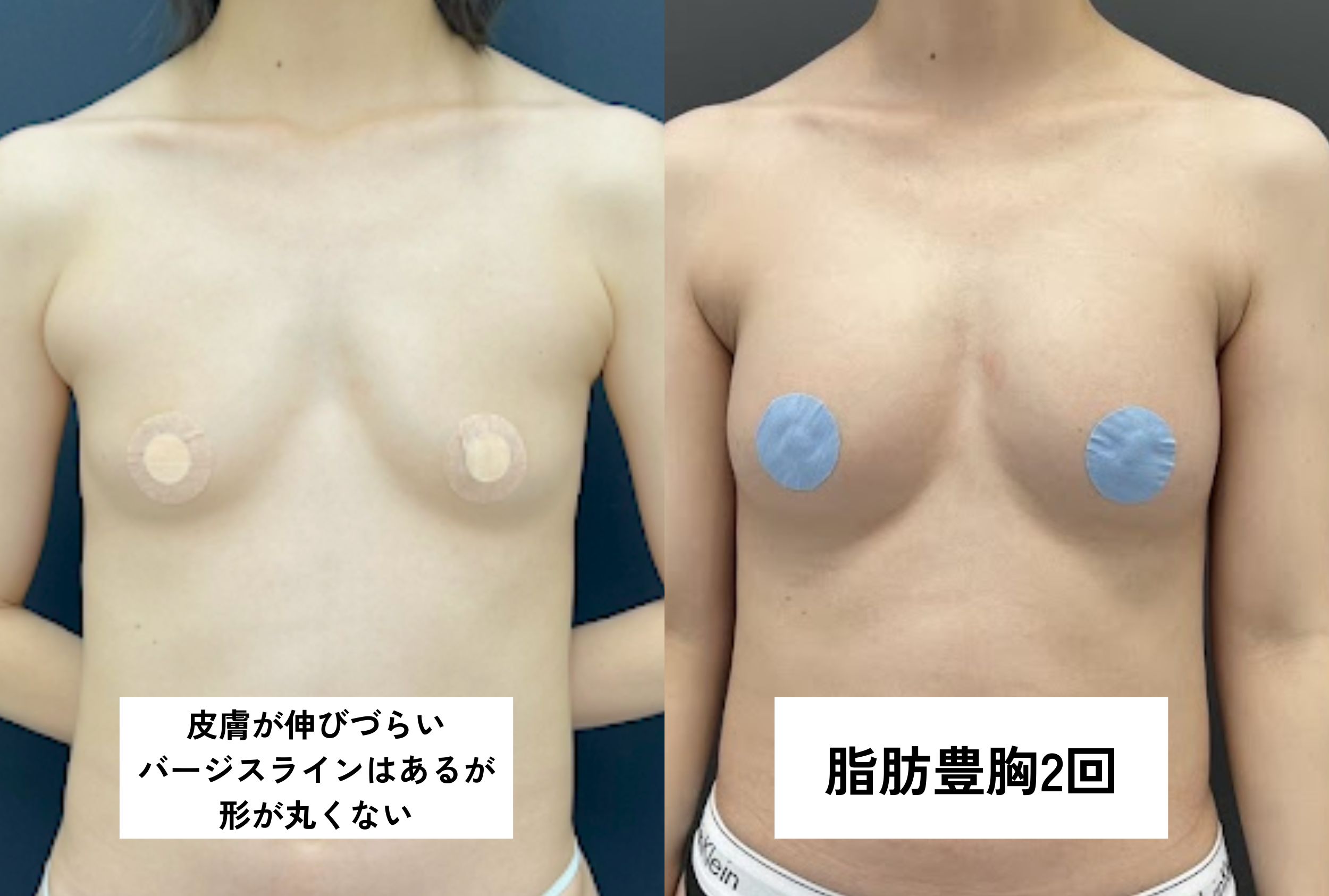 ・バージスあり/授乳歴/施術歴なし/皮膚が硬い/乳腺あり（洋梨型）