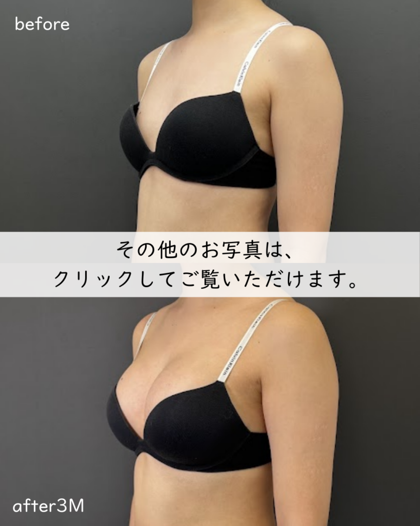 ハイブリット豊胸（Motiva/Ⅿini235）