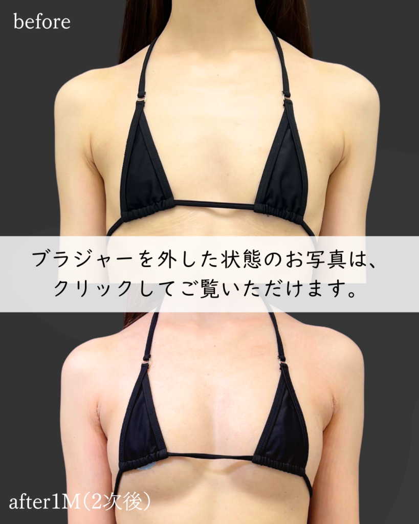 PAL脂肪豊胸×コンデンスリッチ併用×2次豊胸