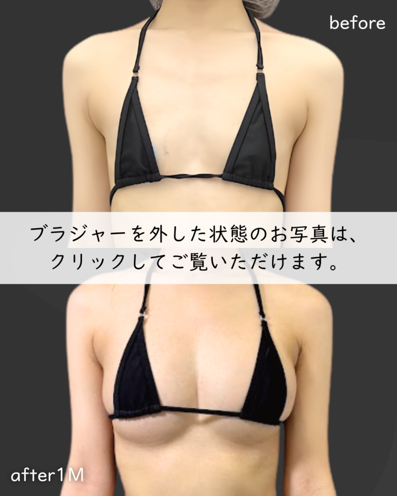 PAL脂肪豊胸（三次）