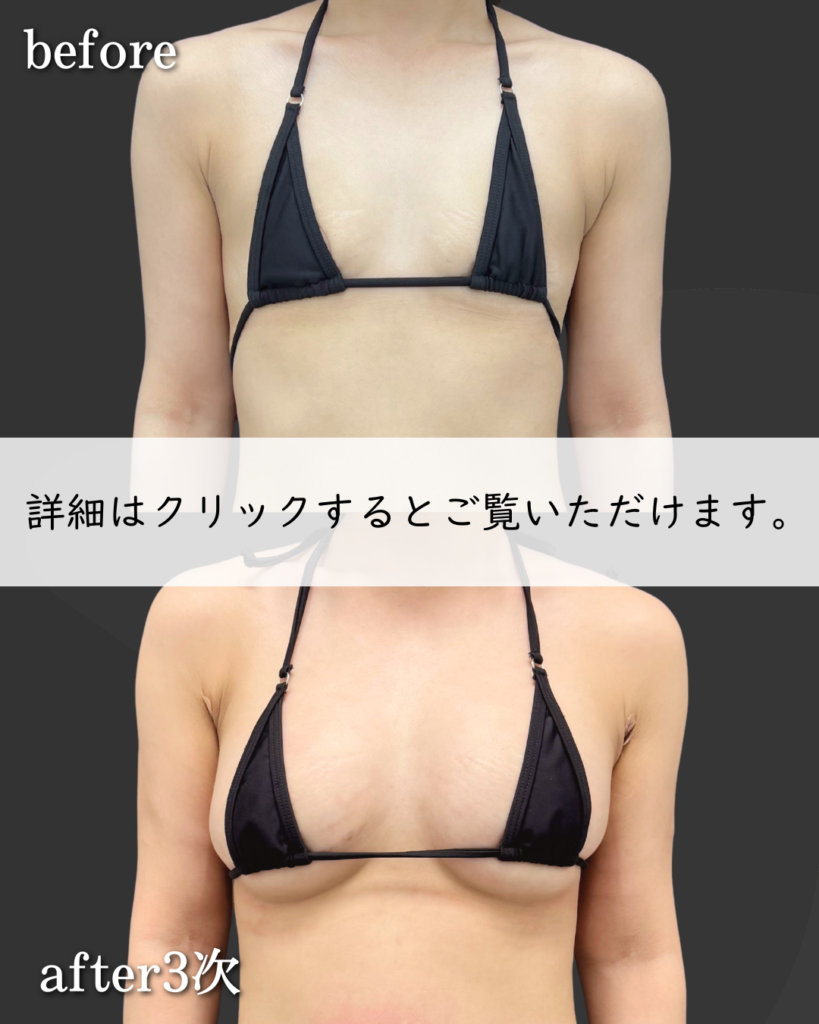 PAL脂肪豊胸×3次豊胸