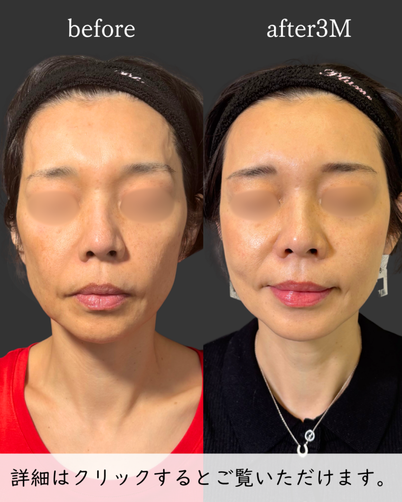 コンデンスリッチ全顔脂肪注入