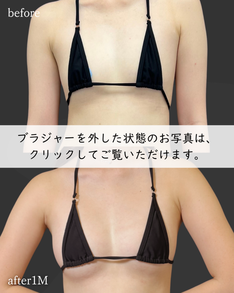 PAL脂肪豊胸×コンデンスリッチ併用