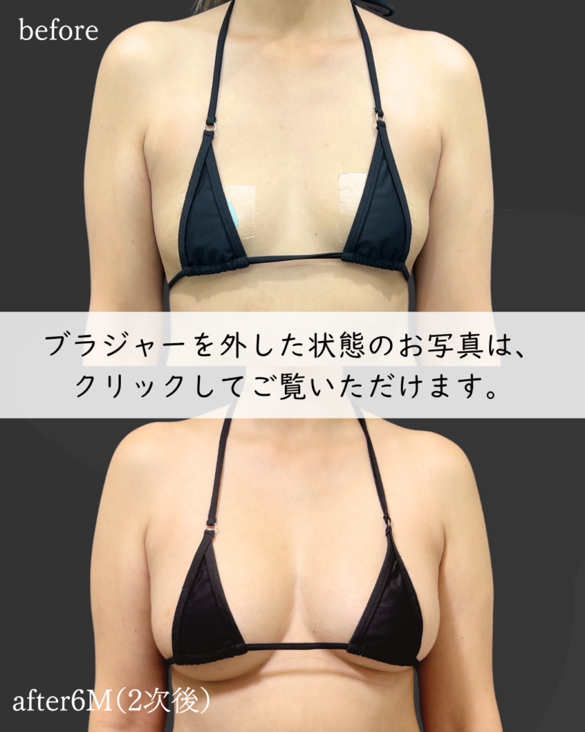 2次PAL脂肪豊胸